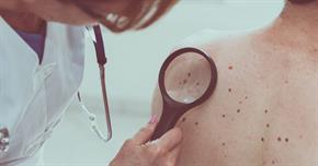 health skin dermatology doctor help gettyimages moles back